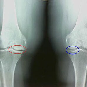 Arthrosis of the knee joint on the radiograph