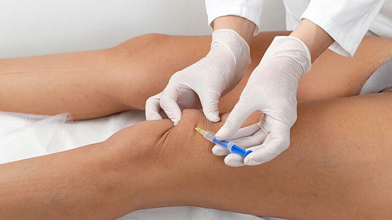Intra -articular injection for arthrosis of the knee